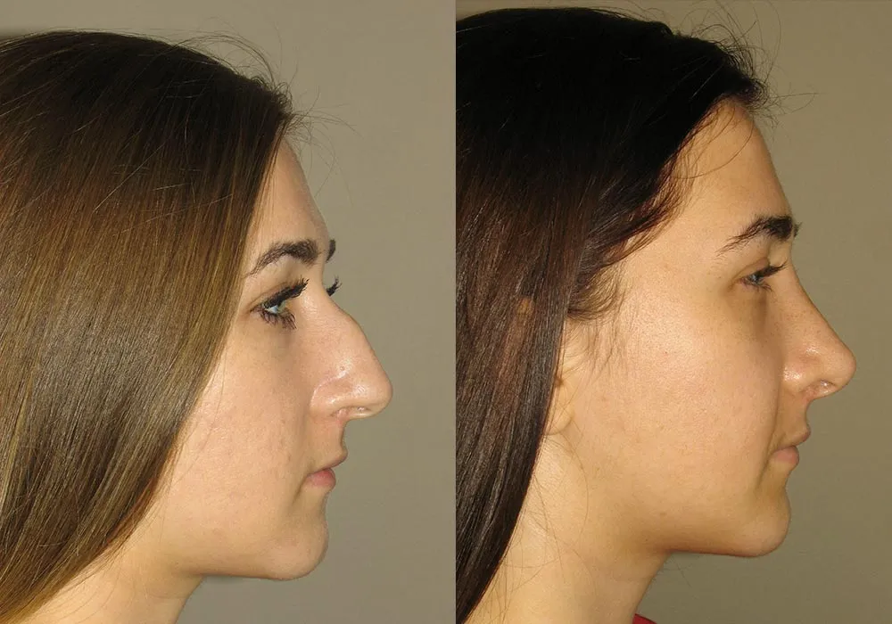 Rhinoplasty Patient 1 | Guyette Facial & Oral Surgery, Scottsdale, AZ
