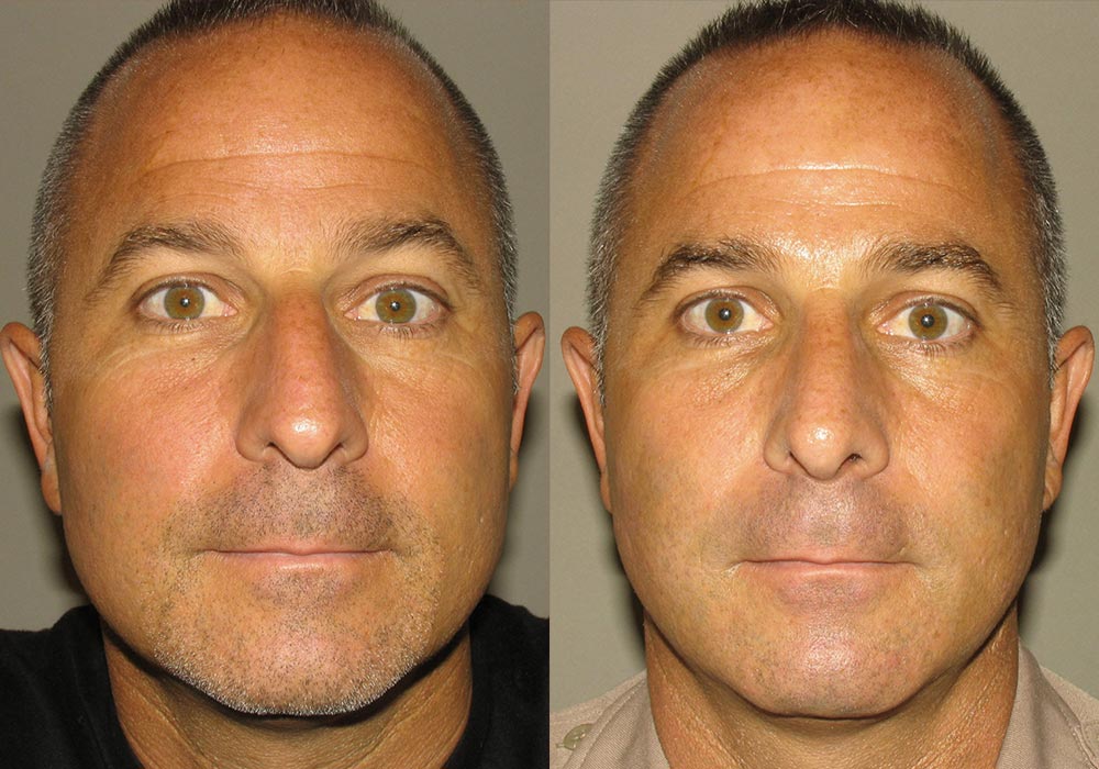 Rhinoplasty Patient 2 | Guyette Facial & Oral Surgery, Scottsdale, AZ