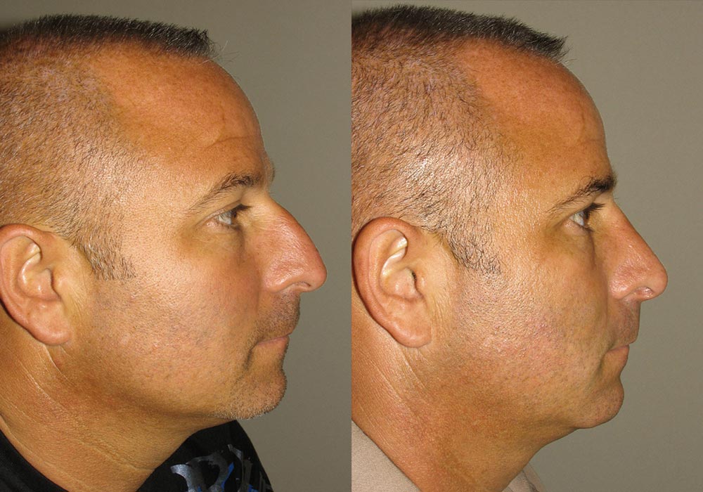 Rhinoplasty Patient 2 | Guyette Facial & Oral Surgery, Scottsdale, AZ