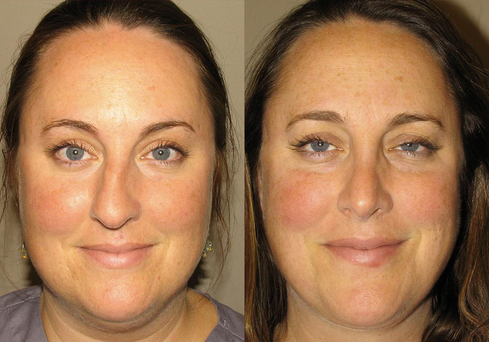 Rhinoplasty patient before and after in Scottsdale & Avondale, AZ.