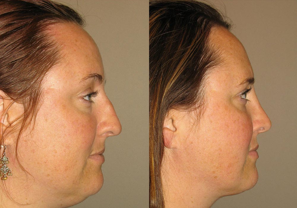 Rhinoplasty Patient 4 | Guyette Facial & Oral Surgery, Scottsdale, AZ