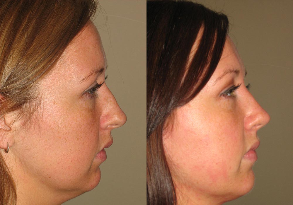 Rhinoplasty Patient 5 | Guyette Facial & Oral Surgery, Scottsdale, AZ