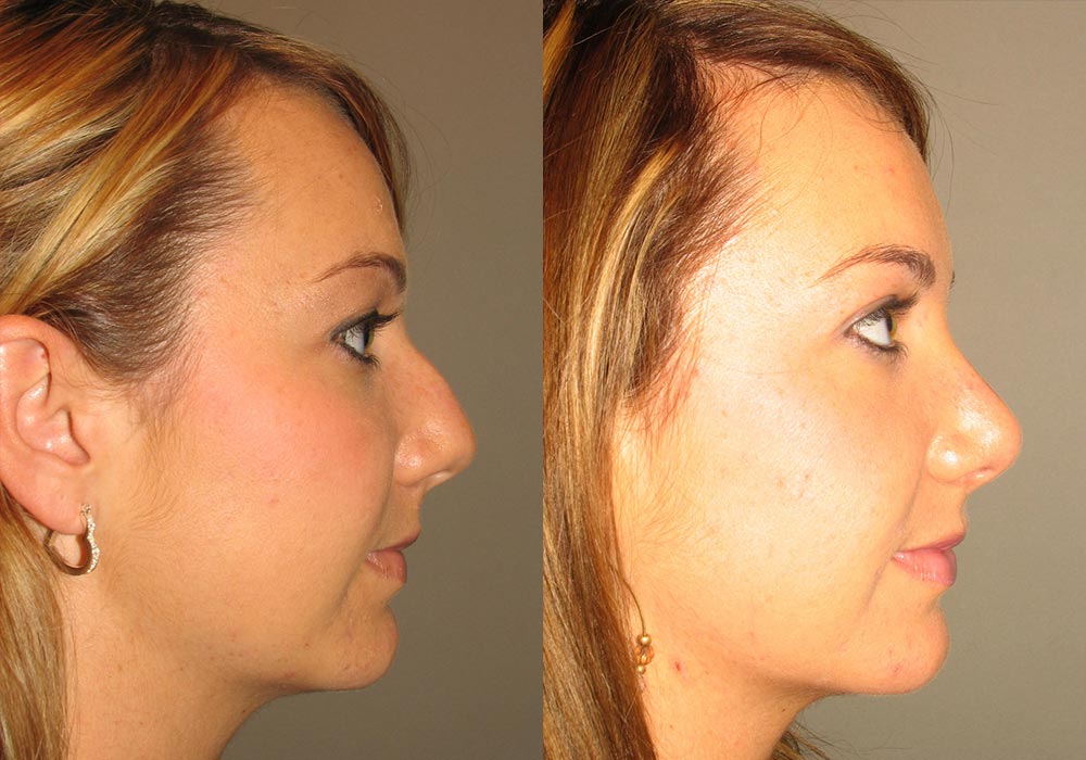 Rhinoplasty Patient 6 | Guyette Facial & Oral Surgery, Scottsdale, AZ