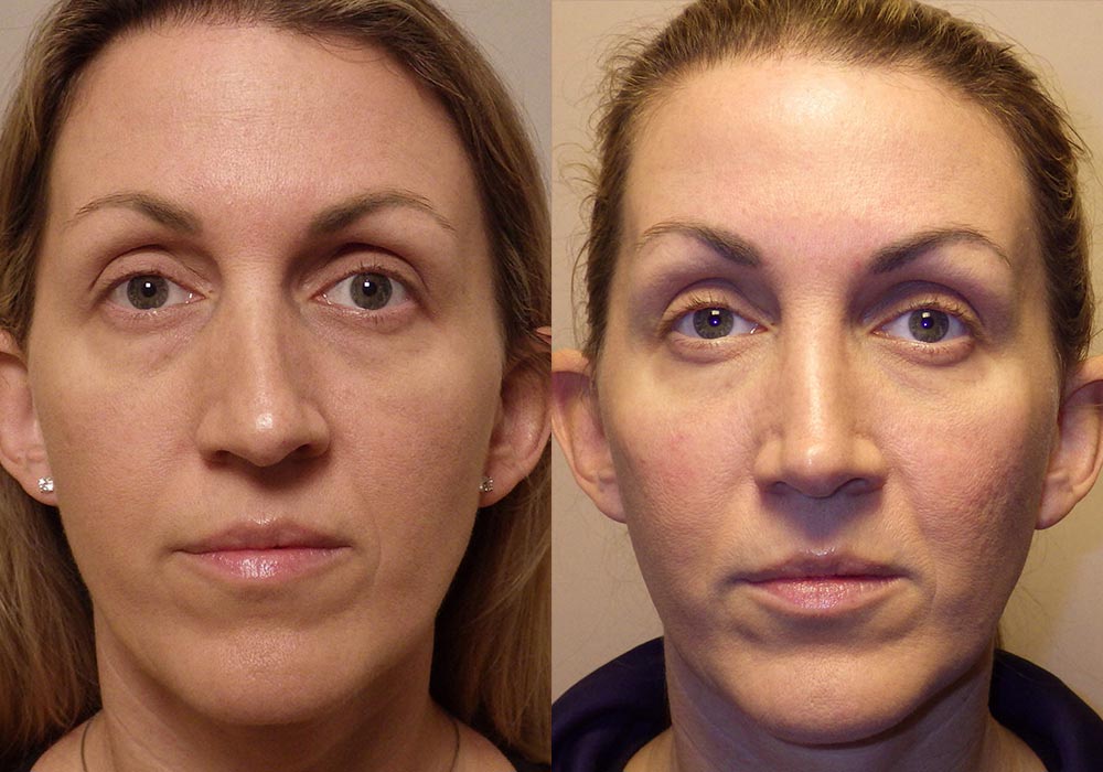 Rhinoplasty Patient 7 | Guyette Facial & Oral Surgery, Scottsdale, AZ