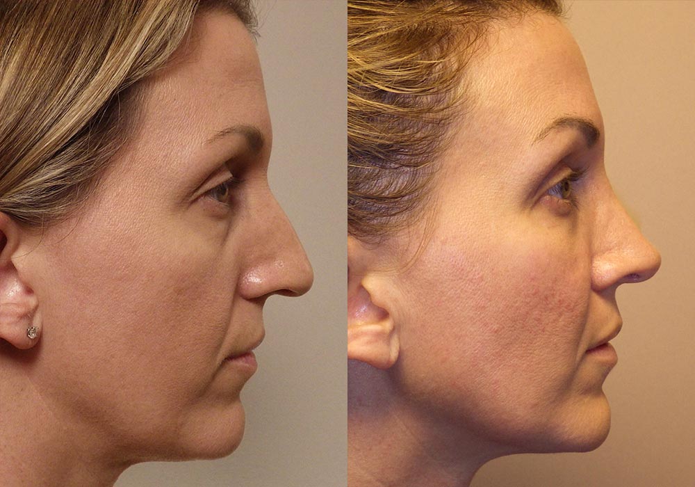 Rhinoplasty Patient 7 | Guyette Facial & Oral Surgery, Scottsdale, AZ