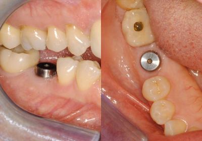 Dental Implants Photo Patient 1 | Guyette Facial & Oral Surgery, Scottsdale, AZ