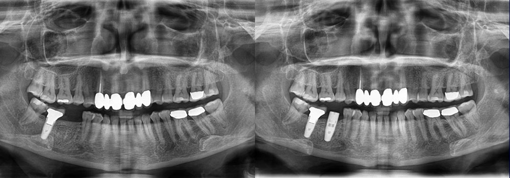 Dental Implants Photo Patient 1 | Guyette Facial & Oral Surgery, Scottsdale, AZ