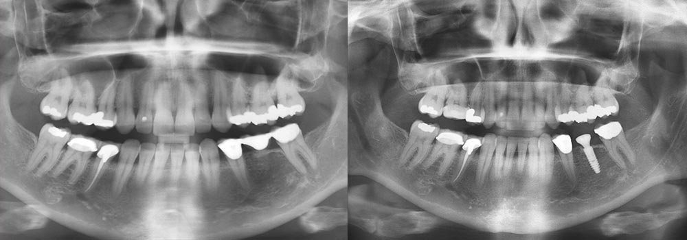Dental Implants Photo Patient 2 | Guyette Facial & Oral Surgery, Scottsdale, AZ