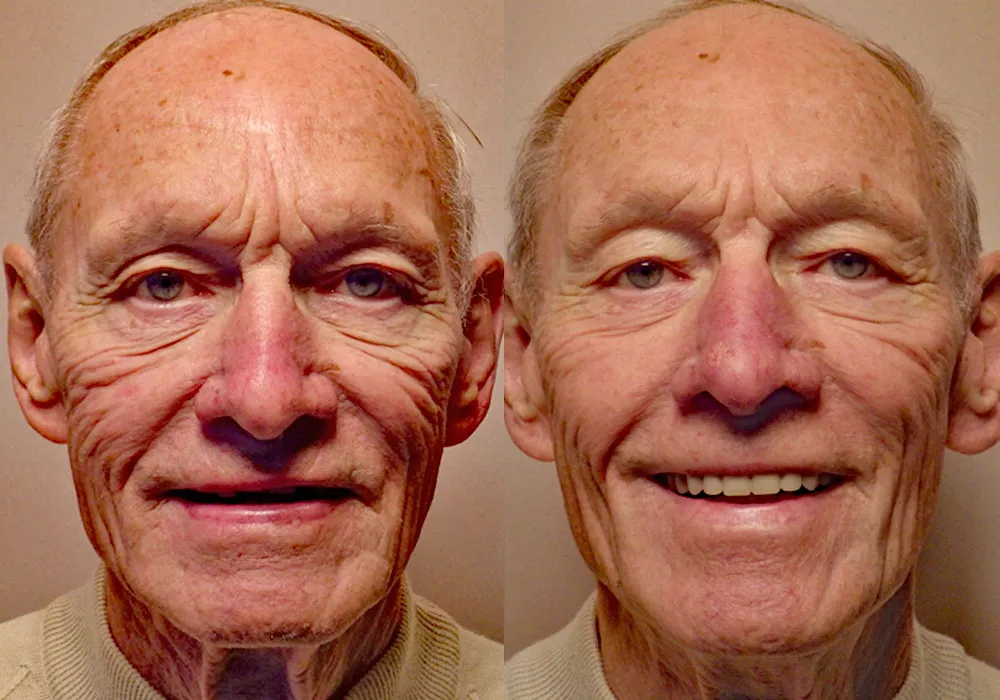 All-on-4 Photo Patient 8 | Guyette Facial & Oral Surgery, Scottsdale, AZ
