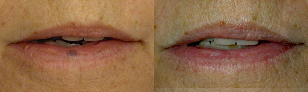 Lesion Removal Patient 2 | Guyette Facial & Oral Surgery, Scottsdale, AZ