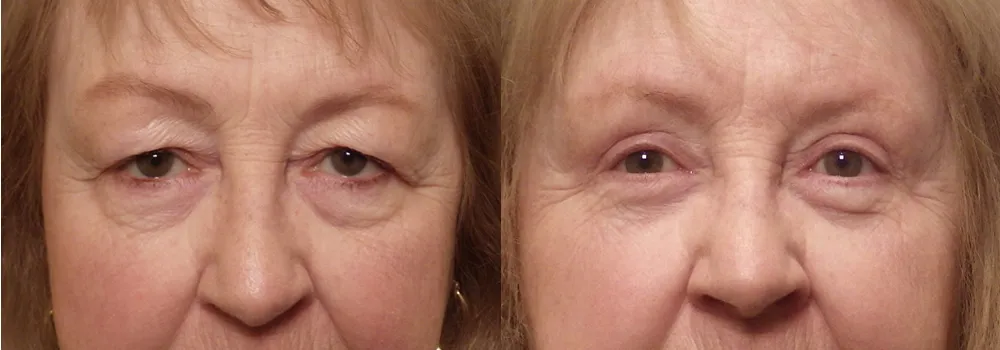 Eyelid Patient 17 | Guyette Facial & Oral Surgery, Scottsdale, AZ