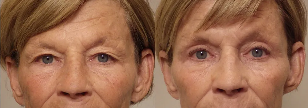 Eyelid patient 18 | Guyette Facial & Oral Surgery, Scottsdale, AZ