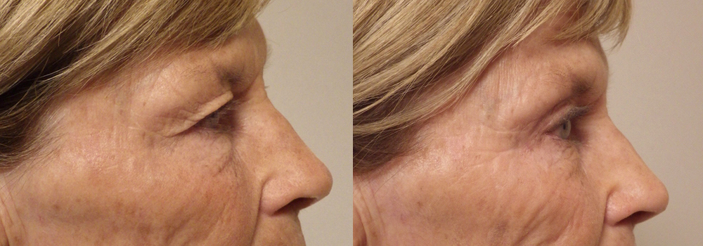 Eyelid Surgery patient 18a | Guyette Facial & Oral Surgery, Scottsdale, AZ