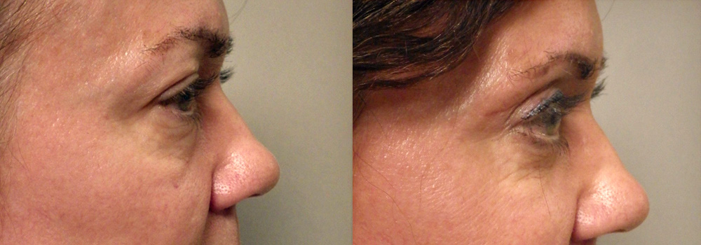 Before & after image of a 56 yr old female who got upper eyelid surgery in Scottsdale & Avondale, AZ