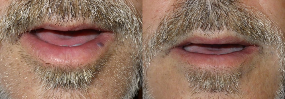 Lesion Removal Patient 4 | Guyette Facial & Oral Surgery, Scottsdale, AZ