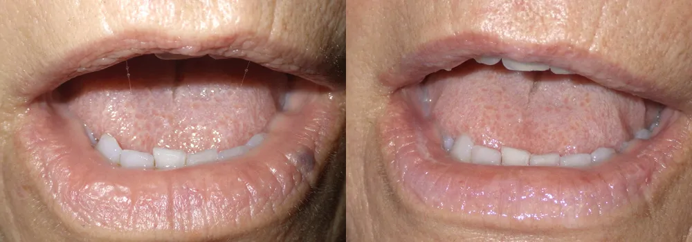 Lesion Removal Patient 3 | Guyette Facial & Oral Surgery, Scottsdale, AZ