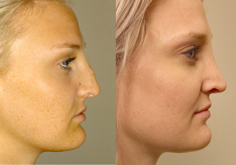 Rhinoplasty Patient 8 - Before & After in Scottsdale & Avondale, AZ