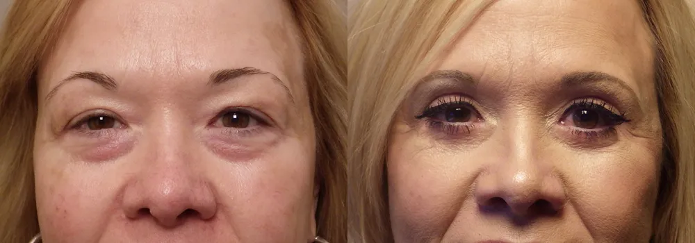 Blephorplasty-patient 19 | Guyette Facial & Oral Surgery, Scottsdale, AZ