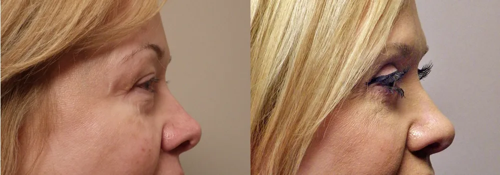 Blephorplasty patient 19 | Guyette Facial & Oral Surgery, Scottsdale, AZ