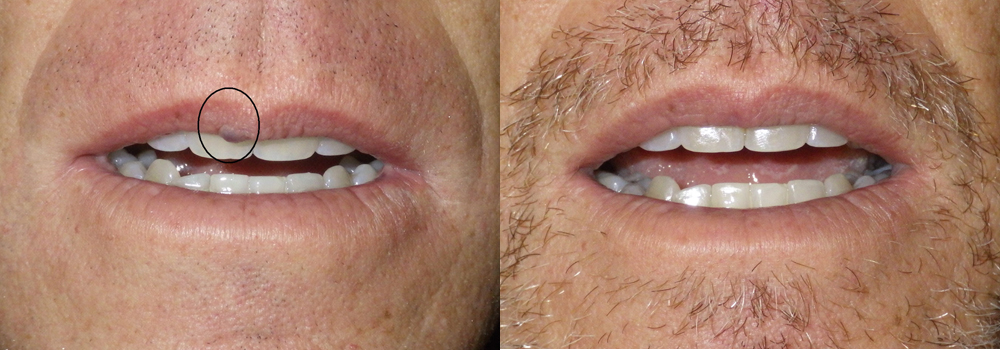 lesion removal patient 5 | Guyette Facial & Oral Surgery, Scottsdale, AZ