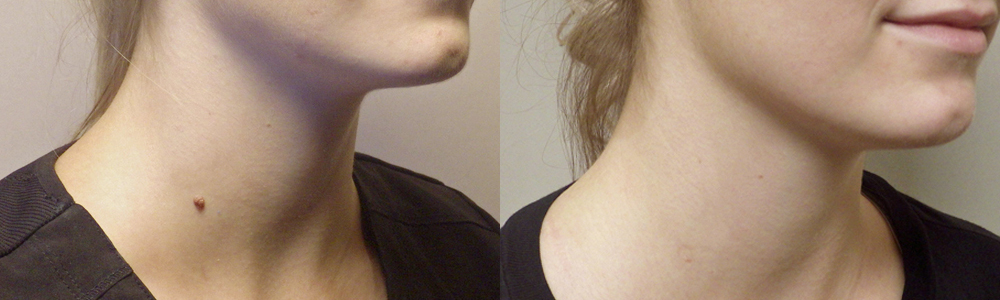 Guyette mole removal Scottsdale Avondale
