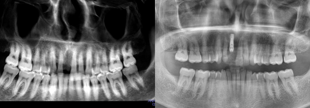 Dental Implant patient 3 | Guyette Facial & Oral Surgery, Scocttsdale, AZ