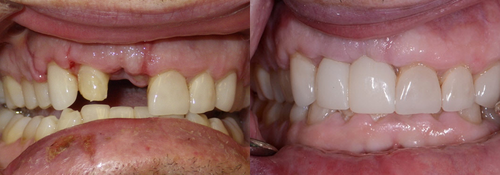 Dental IMmplant patient 3 | Guyette Facial & Oral Surgery, Scottsdale, AZ