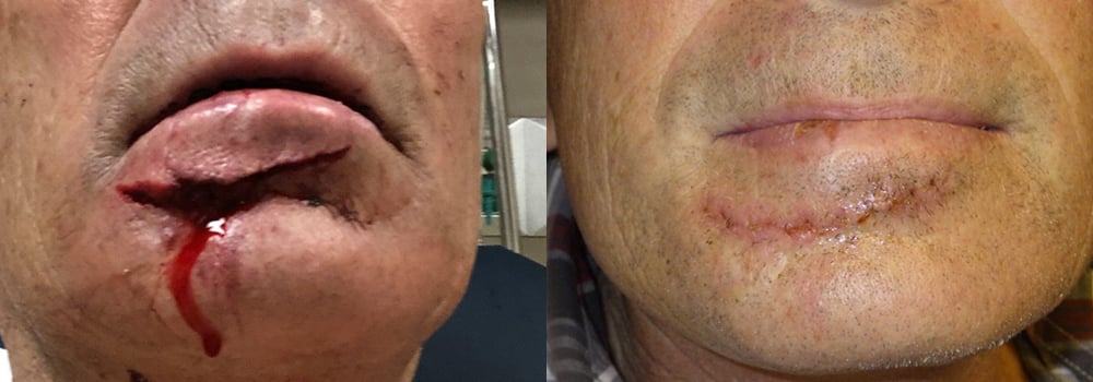 Dental Implant patient 3 | Guyette Facial & Oral Surgery, Scottsdale, AZ