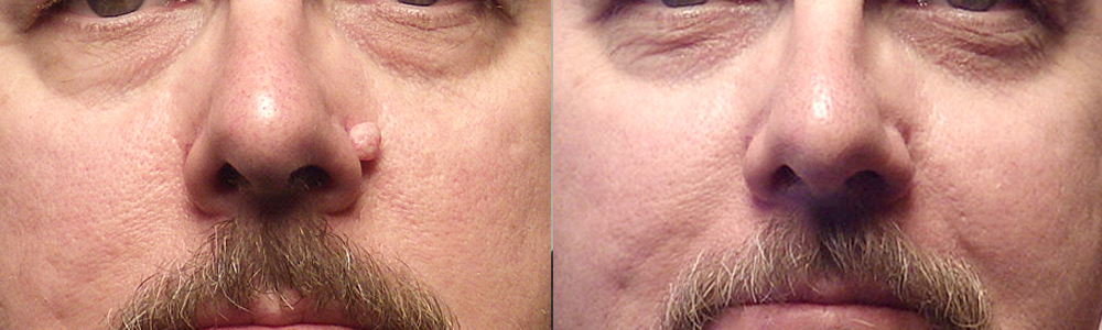 Guyette_mole_removal_Scottsdale_Avondale