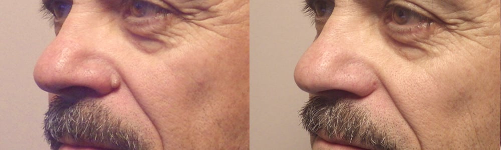 Dr Guyette_Mole_Removal_ Scottsdale_Avondale_Phoenix