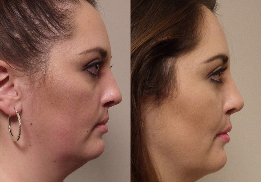 Rhinoplasty Patient 10 | Guyette Facial & oral Surgery, Scottsdale AZ