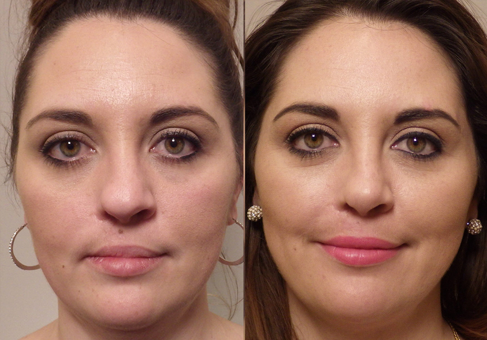 Rhinoplasty Patient 10 | Guyette Facial & Oral Surgery, Sccottsdale AZ