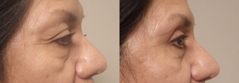 Guyette bleph upper and lower lateral 20 b