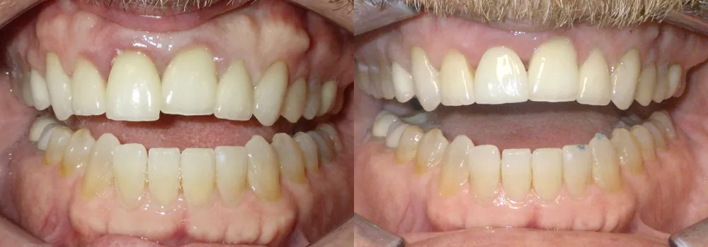 Detnal Implant Patient 6 | Guyette Facial & Oral Surgery