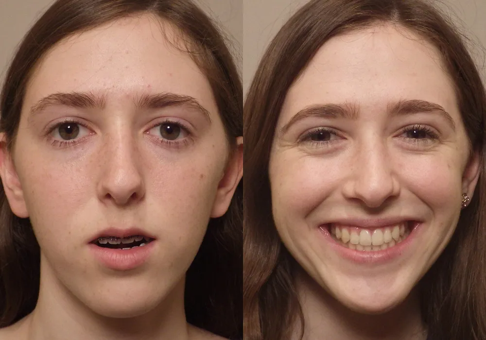 Jaw-Surgery Photo Patient 7 | Guyette Facial & Oral Surgery, Scottsdale, AZ