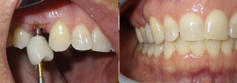 Dental Implants Photo Patient 7 | Guyette Facial & Oral Surgery, Scottsdale, AZ