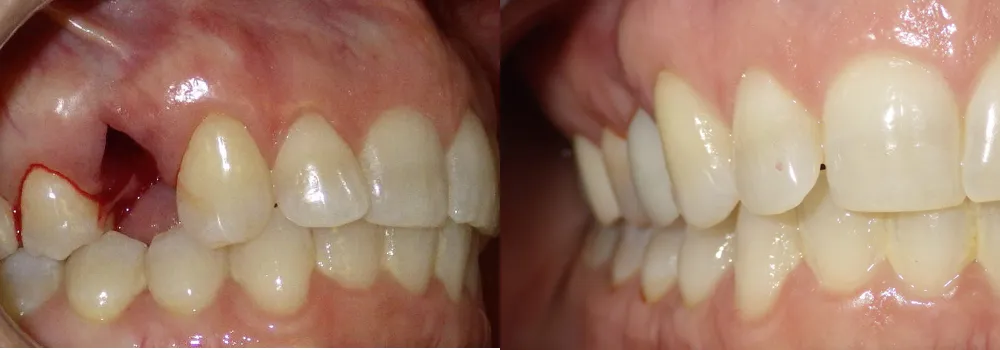 Dental Implants Photo Patient 7 | Guyette Facial & Oral Surgery, Scottsdale, AZ