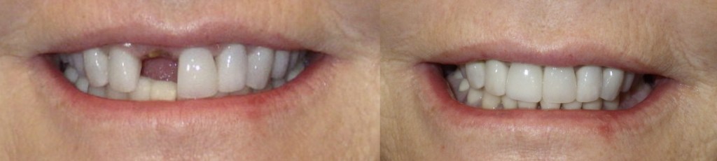 Before and after of an immediate temp tooth 2