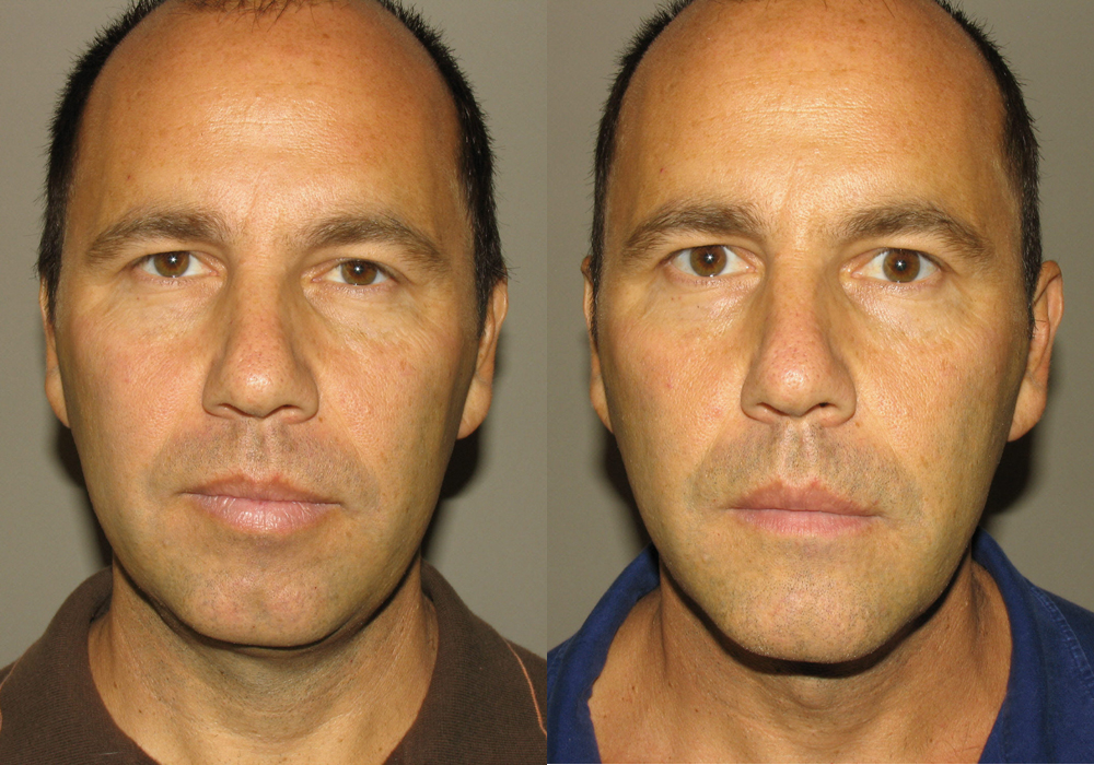 Facial Implant Photo Patient 3 | Guyette Facial & Oral Surgery, Scottsdale, AZ
