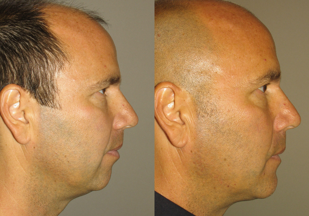 Genioplasty Facial-Surgery Photo Patient 5 | Guyette Facial & Oral Surgery, Scottsdale, AZ
