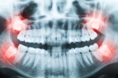 Wisdom Teeth Removal in Scottsdale & Avondale, AZ