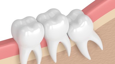 Illustration of an impacted wisdom tooth