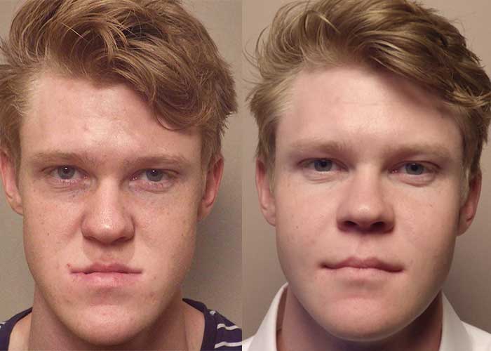 Frontal view of patient before and after corrective jaw surgery