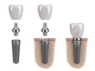 Implant-Supported Dentures in Scottsdale & Avondale, AZ