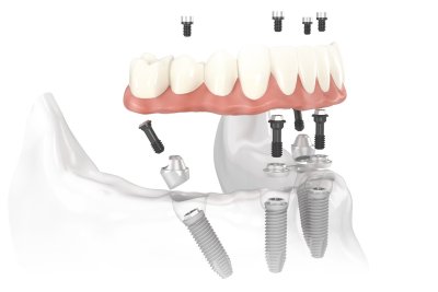 All-on-4 / Teeth In A Day in Scottsdale & Avondale, AZ
