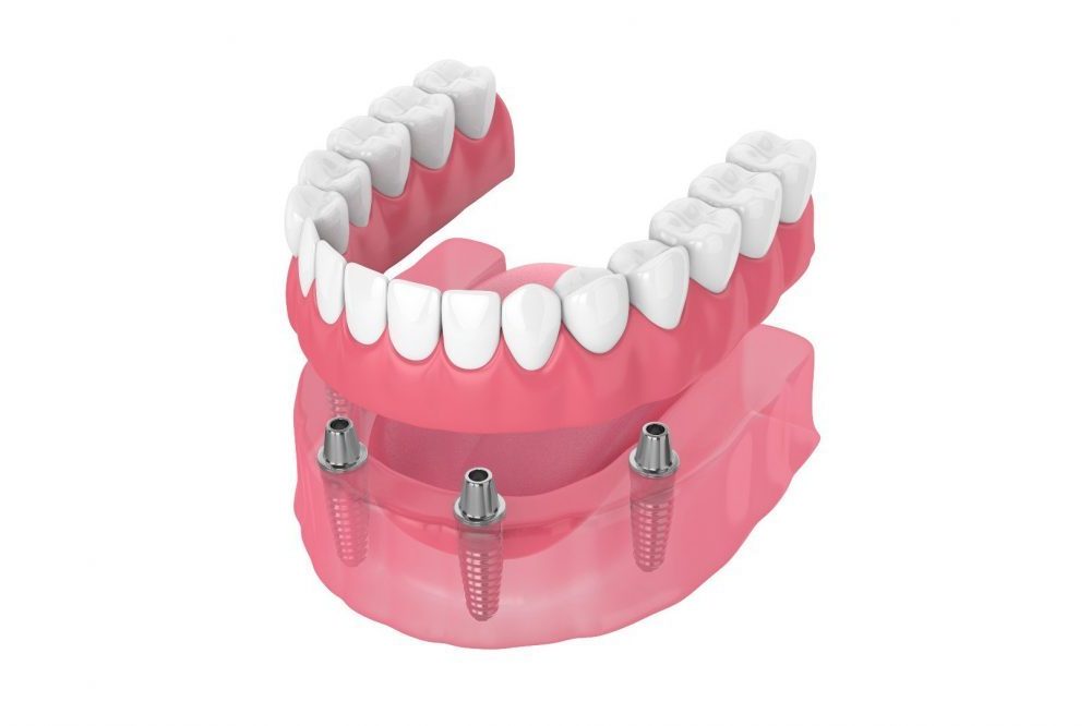 Sinus and Bone Grafting in Scottsdale & Avondale, AZ