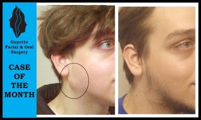Cyst Removal photo patient 1 | Guyette Facial_&_Oral_Surgery, Scottsdale AZ Cyst