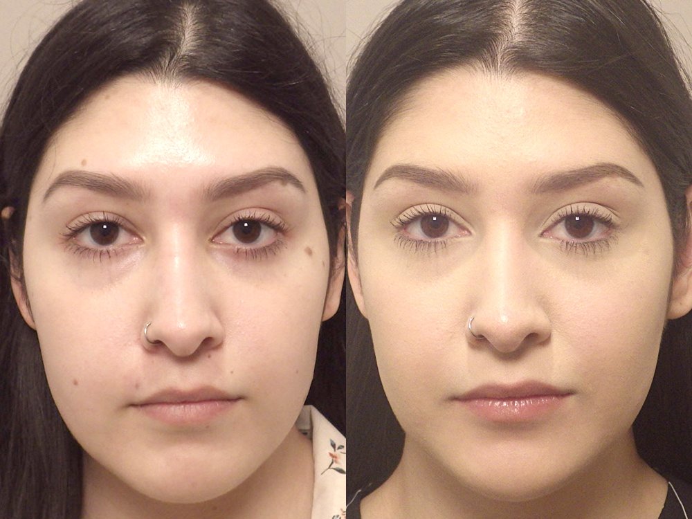 Facial mole removal photo patient 11 front view | Guyette Facial & Oral Surgery, Scottsdale, AZ