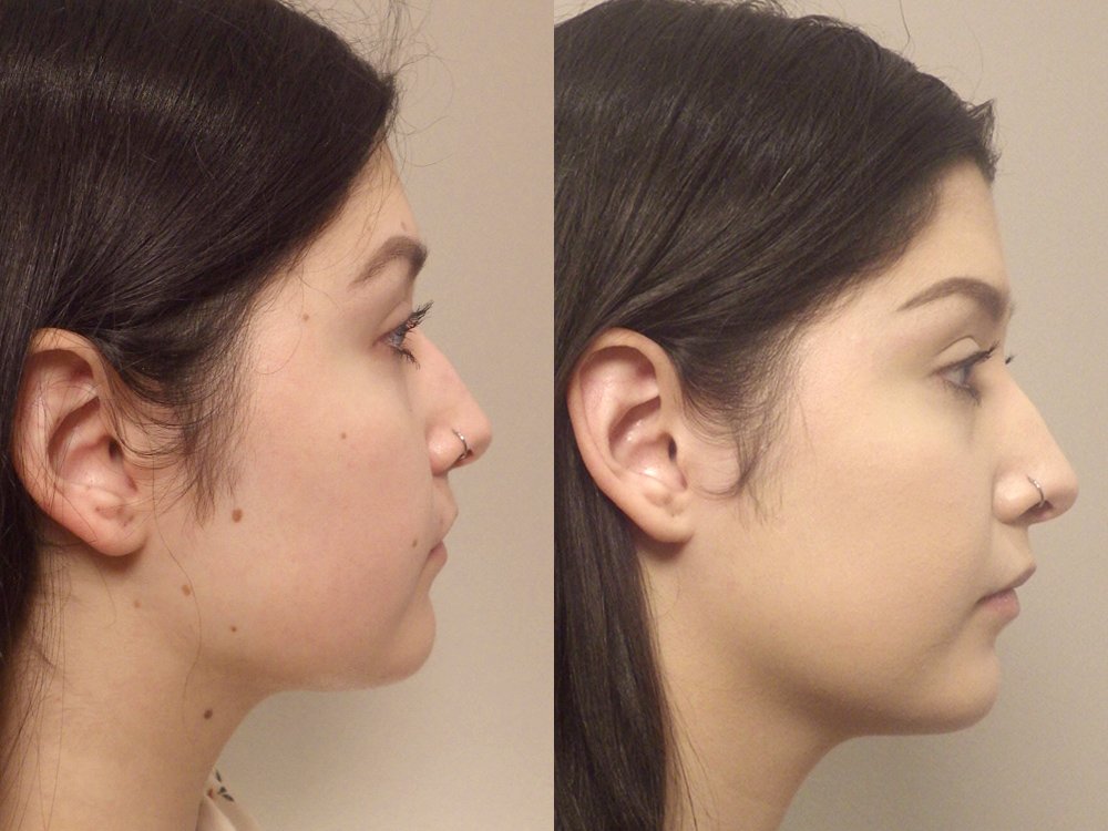 Facial mole removal photo patient 11 side view | Guyette Facial & Oral Surgery, Scottsdale, AZ