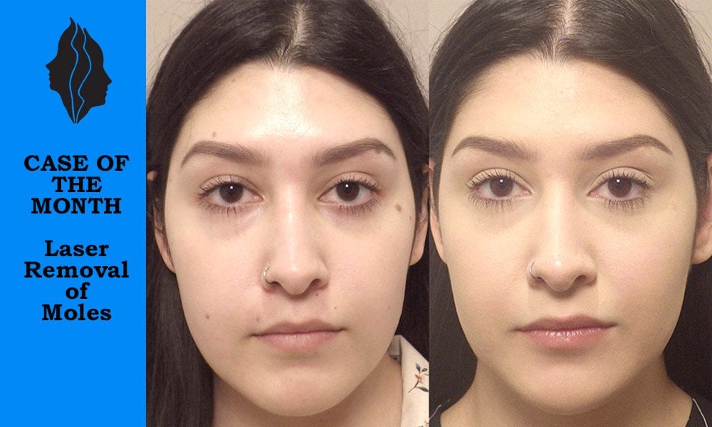 Mole Removal Patient - Before & After in Scottsdale & Avondale, AZ